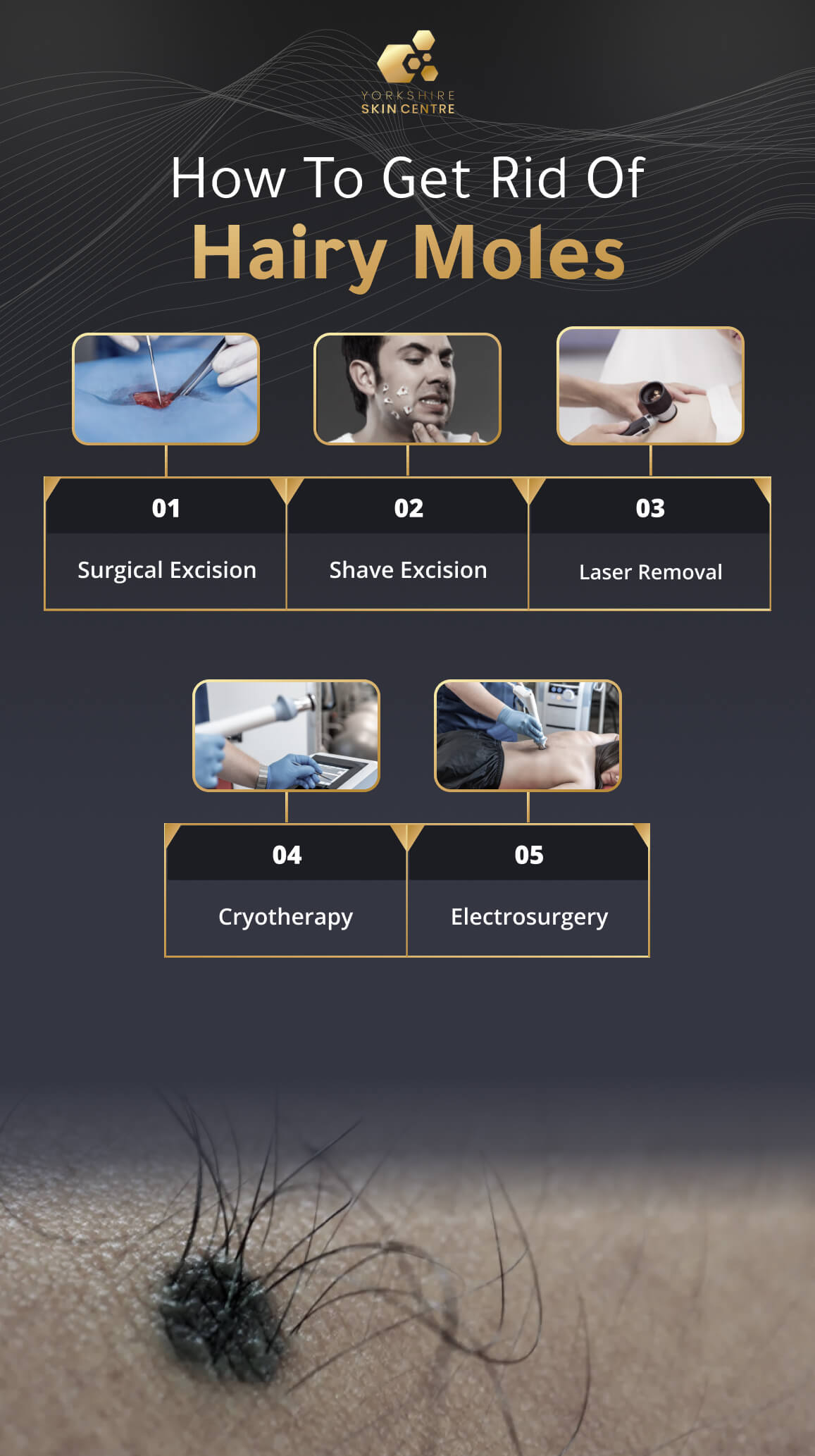 How To Get Rid Of  Hairy Moles